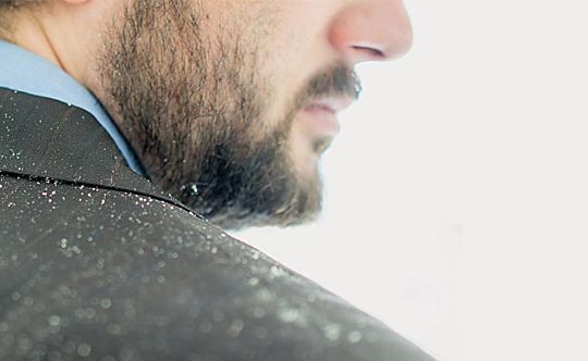 dandruff-and-dry-scalp