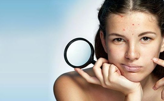 6-best-ways-to-manage-acne