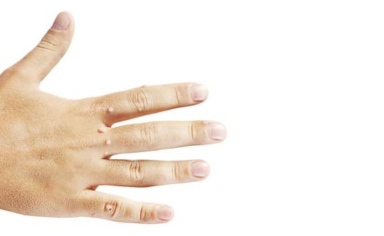 6-ways-to-beat-warts