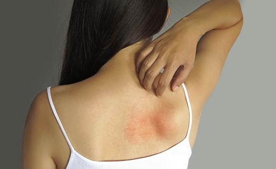 9-tips-to-treat-skin-rashes