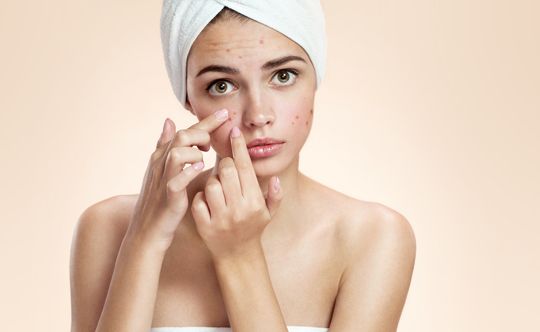 people who can get affected with acne