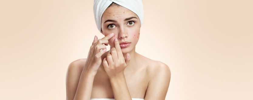 people who can get affected with acne