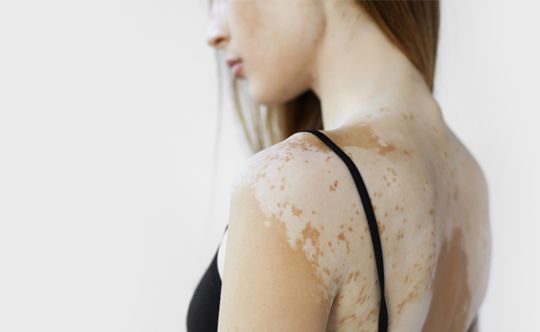 causes-of-vitiligo