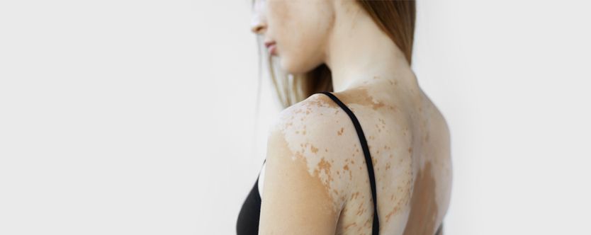 causes-of-vitiligo
