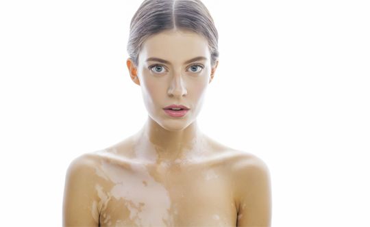 people-who-can-get-affected-by-vitiligo-width-834-height-332