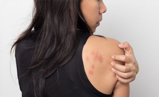 people-who-can-get-affected-with-urticaria