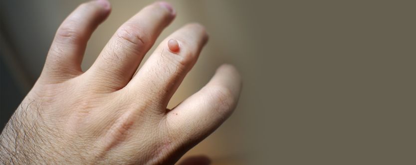 people who can get affected with warts