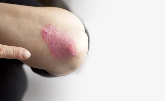 People who may suffer from Psoriasis