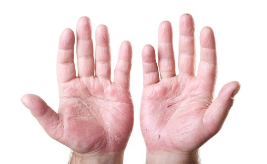 Causes for Psoriasis