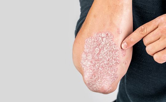 symptoms of psoriasis
