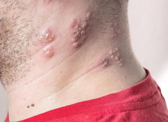 people who suffer from Lichen planus