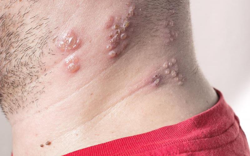 people who suffer from Lichen planus
