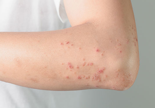 What Is Lichen Planus Health Total