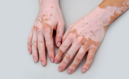 symptoms-of-vitiligo