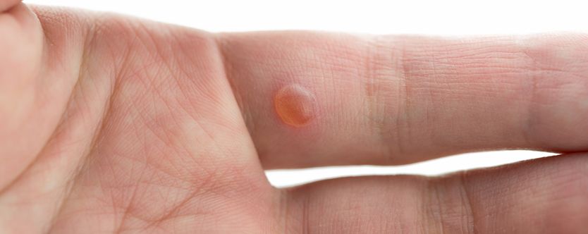 symptoms of warts