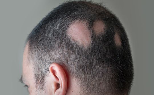 what-is-alopecia-width-834-height-332