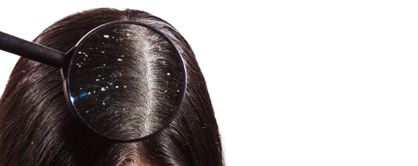 Understand what Dandruff is and How it is caused | Health Total