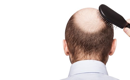 what is male pattern baldness