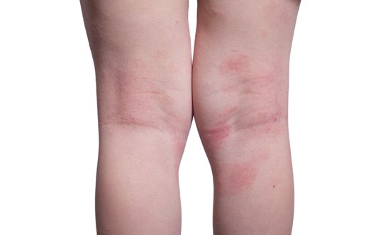 what is psoriasis
