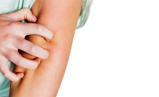 what is urticaria