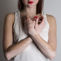 what is vitiligo