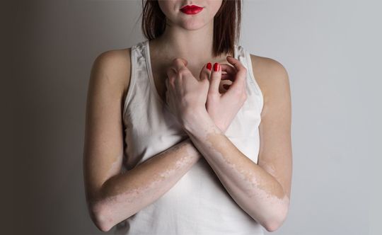 who often suffers from vitiligo