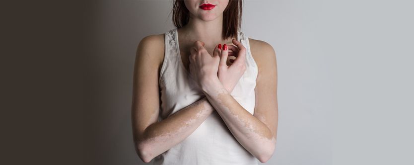 who often suffers from vitiligo