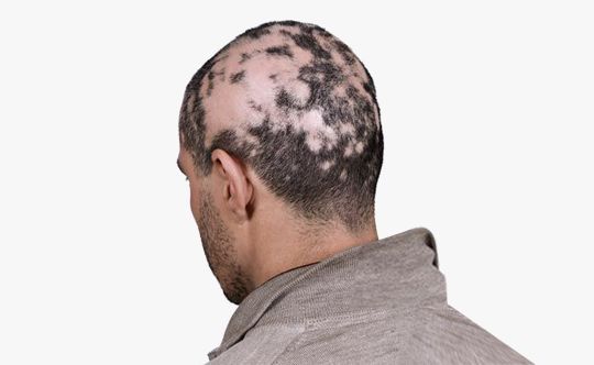 alopecia-areata-scalia-gallery-fullwidth
