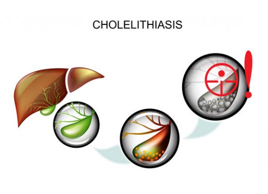 cholecystitis