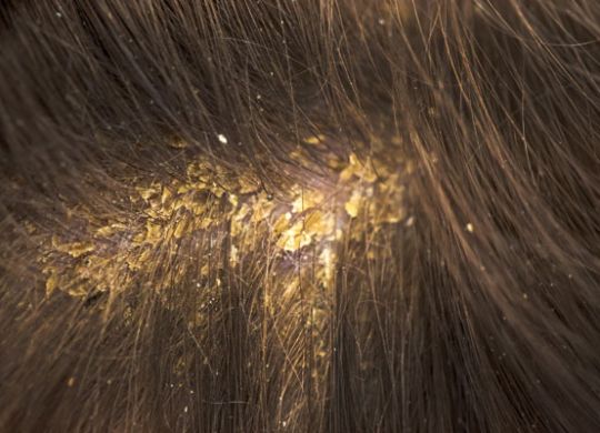 dandruff-seborrhoea