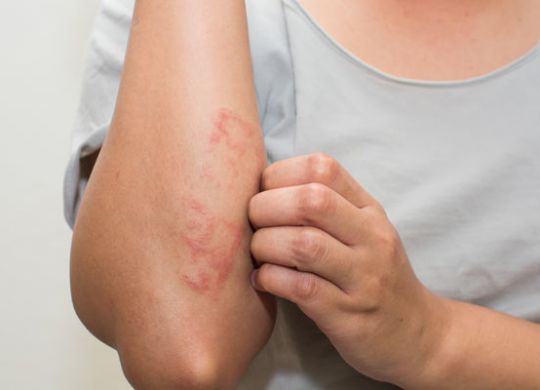 eczema-dermatitis