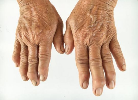 gout-arthritis