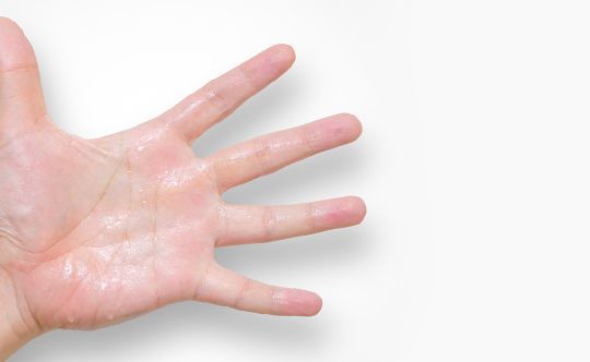 Homeopathic Treatment for hyperhidrosis Sweating of Hands Feet