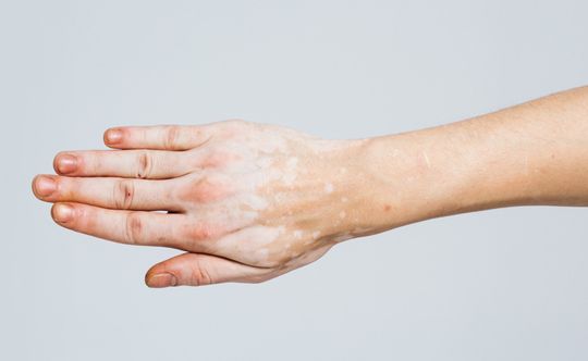 homeopathic-remedies-for-vitiligo