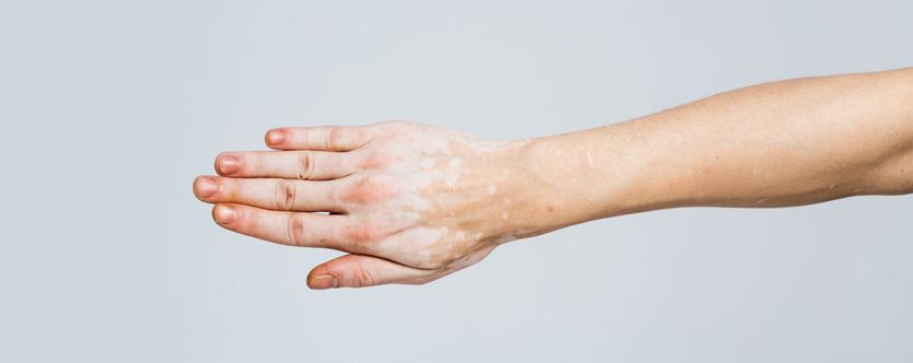 homeopathic-remedies-for-vitiligo