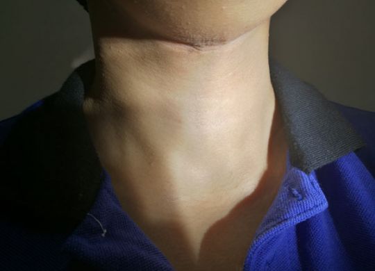 hyperthyroid