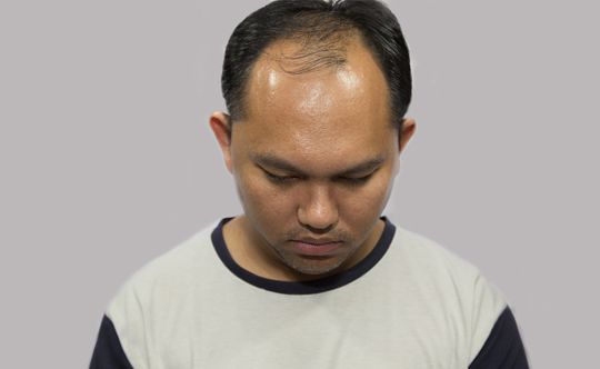 male-pattern-baldness-scalia-gallery-fullwidth