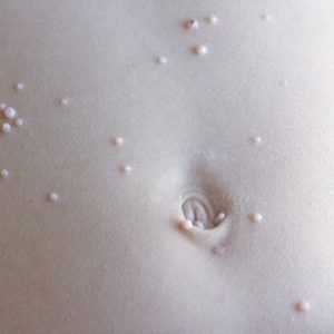 molluscum-contagiosum-300x300