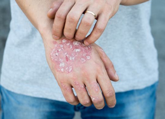 psoriasis