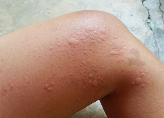 urticaria