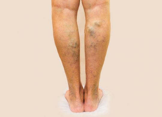 varicose-veins