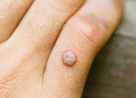 warts