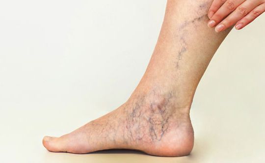 varicose-veins-banner