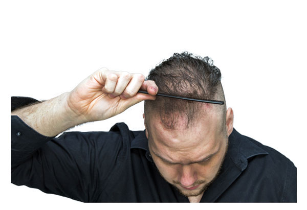 Homeopathy Plan for Androgenetic Alopecia