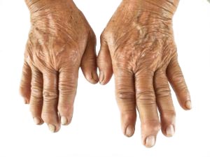 Rheumatoid arthritis