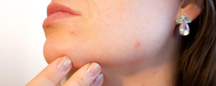home remedies to treat acne