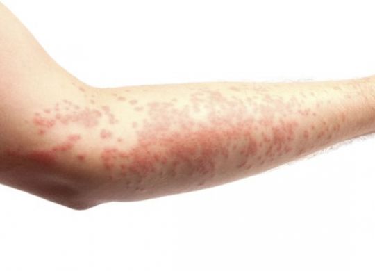Symptoms of Lichen Planus