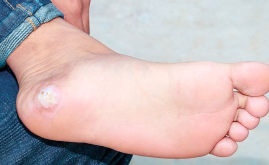 Home remedies for warts