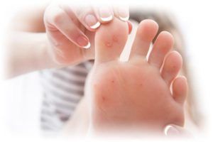 Plantar warts