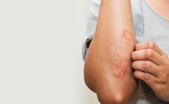 Tips to manage psoriasis
